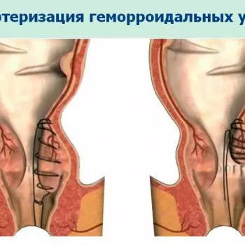 Лечение геморроя методом дезартеризации